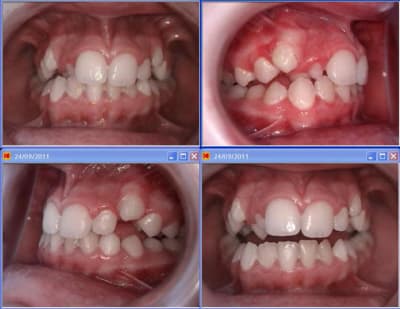 Photo canine incluse x53v94 - Eugenol