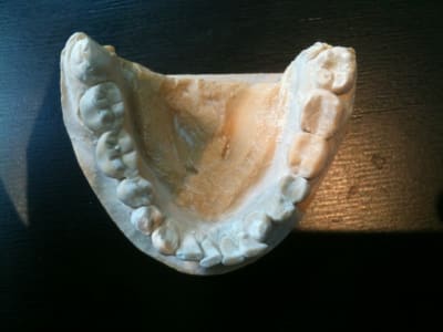 Photo mandibule uoowdt - Eugenol