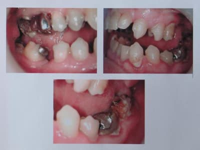 Photo patient aphte xlplia - Eugenol
