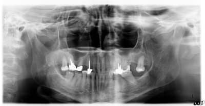 Post op  2  y3limm - Eugenol