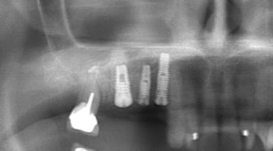 Post op summers sqmlbd - Eugenol