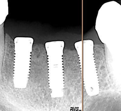 Premiers implants isd7qx - Eugenol