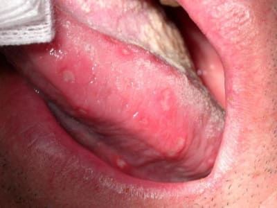 Primoinfection herpes 2 aheyt2 - Eugenol