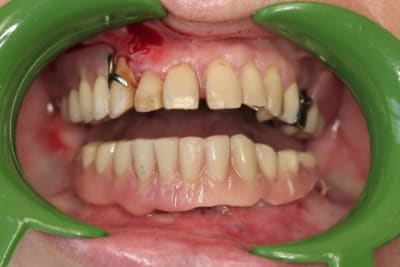 Prothèse en place gojmqp - Eugenol