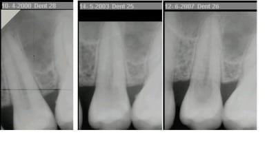 Résorption interne ae3tsb - Eugenol