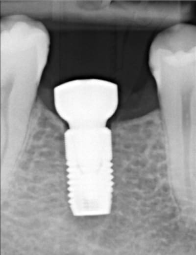 Radiopost verili - Eugenol
