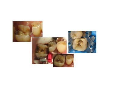 Reconstitution pré endo flow ustlwm - Eugenol