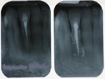 Resorption lrro8t - Eugenol