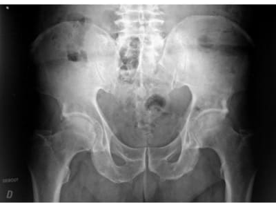 Rhumatologie radiographie bassin normale qjuicrh1lq f5biiu - Eugenol