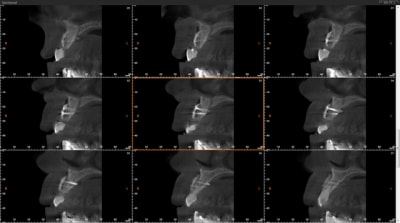 Scan post op ozkflr - Eugenol