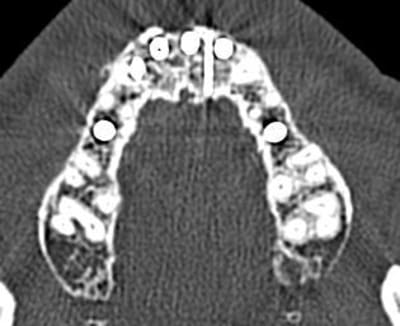 Scanner implant 12 iv dajizt - Eugenol