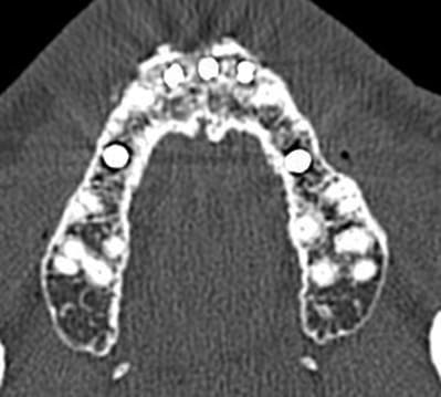 Scanner implant 12 vii iqzdvm - Eugenol