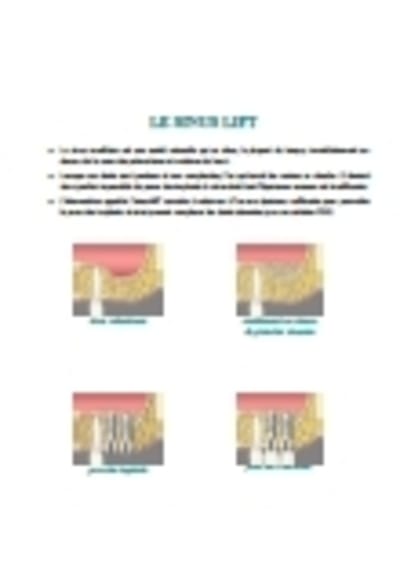 Sinus lift  12 - Eugenol