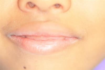 Sourire gingival   6 ans 005  medium  easjlf - Eugenol