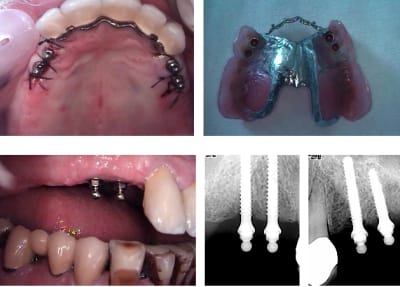Stellite   mini implant immédiat sm1rmr - Eugenol