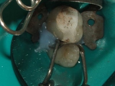 Strat dentine kjbnme - Eugenol