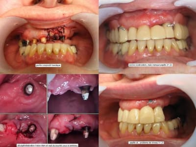 Suite greffe 1 hvnwei - Eugenol