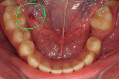 Tache rouge xhuxtu - Eugenol
