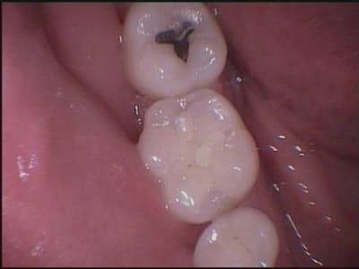 Toujours pas de carie qpxvj6 - Eugenol