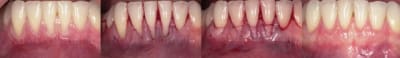 Tunnelisation   conjonctif enfoui pssctt - Eugenol