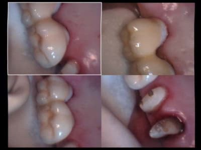 Un cas difficile bridge scellé sur piliers vissés implants 16 et 17 dtckm7 - Eugenol