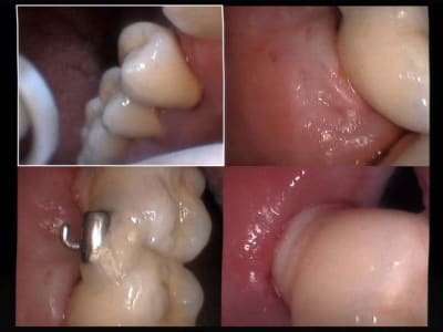 Un cas difficile vue rapprochée haut droit presque fin g2ng6j - Eugenol