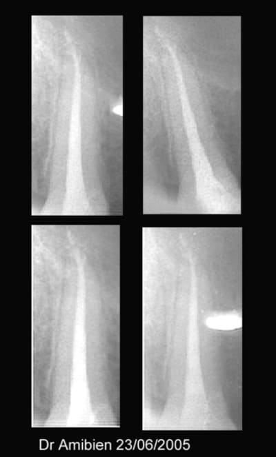 Une endo laser copy dg4ojx - Eugenol