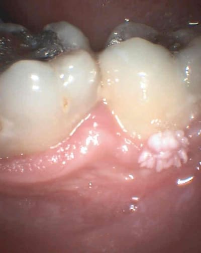 Verrue msj5zf - Eugenol