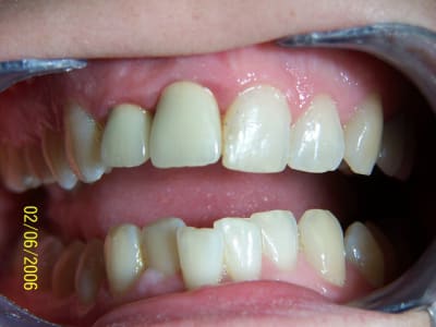 Vitt1 akrvfa - Eugenol