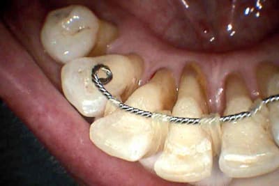 Vue linguale clqsyc - Eugenol