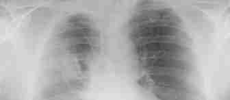 A chest X-ray showing the ribs, spine, heart, and lung fields. The image displays the internal structures of the chest in black, white, and gray shades, with no visible labels or markings.