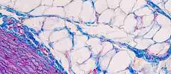 A microscopic image of connective tissue stained with Masson's trichrome. The image shows a mix of blue, red, and pink hues, displaying fibrous and adipose tissue. Blue staining highlights collagen fibers, while muscle and cytoplasm appear in shades of red and pink.