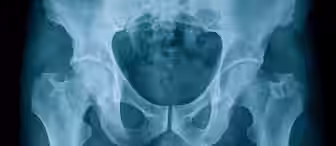 X-ray image of a human pelvic region, showing the hip bones, sacrum, and upper femurs. The bones appear in shades of white against a dark background, highlighting their structure and alignment.