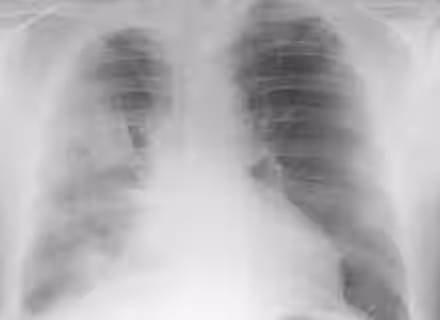 A chest X-ray showing the ribs, spine, heart, and lung fields. The image displays the internal structures of the chest in black, white, and gray shades, with no visible labels or markings.