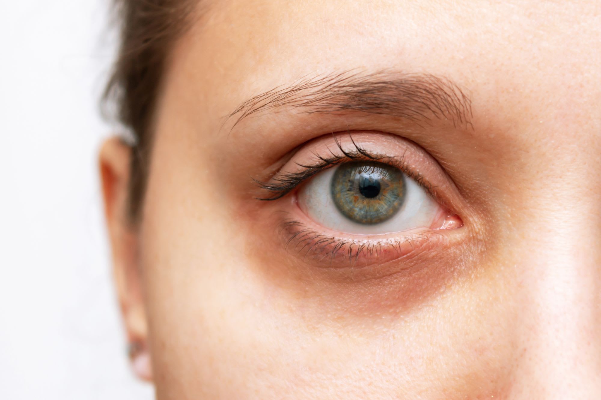 Augenringe entfernen: Tipps für eine vitale Ausstrahlung