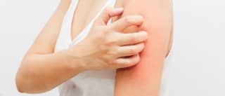 Atopijski dermatitis
