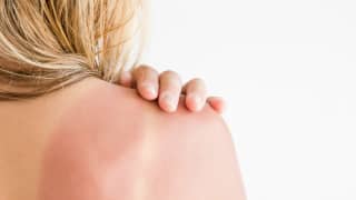 Solarni dermatitis