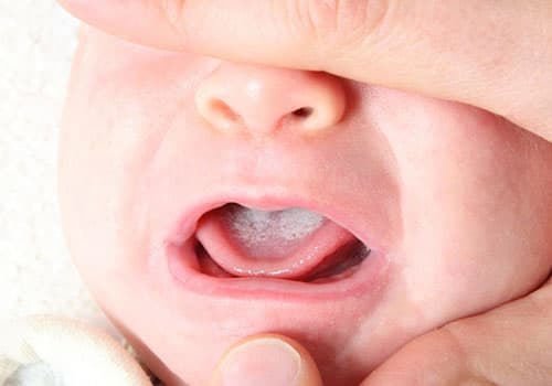 NGUYÊN NHÂN CỦA TÌNH TRẠNG BÉ LƯỜI BÚ LÀ GÌ? BÉ LƯỜI BÚ THÌ PHẢI LÀM SAO?