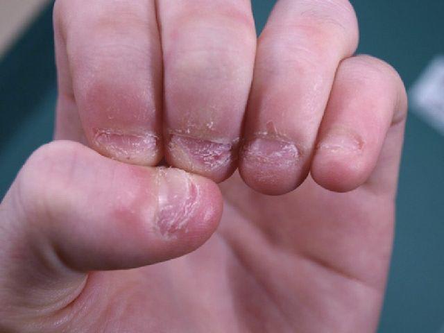 Trẻ hay cắn móng tay là thiếu chất gì? Nguyên nhân và cách khắc phục