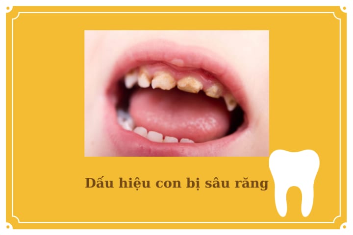 DẤU HIỆU CON BỊ SÂU RĂNG? NHỮNG THÓI QUEN GÂY HẠI CHO RĂNG CỦA CON