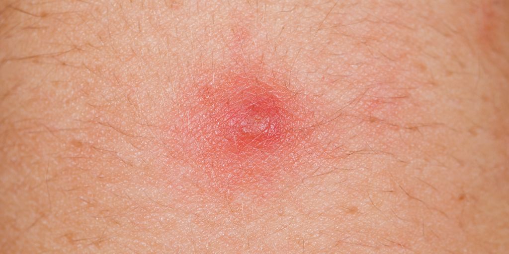 What S On My Skin 8 Common Bumps Lumps And Growths Skin Health Sharecare