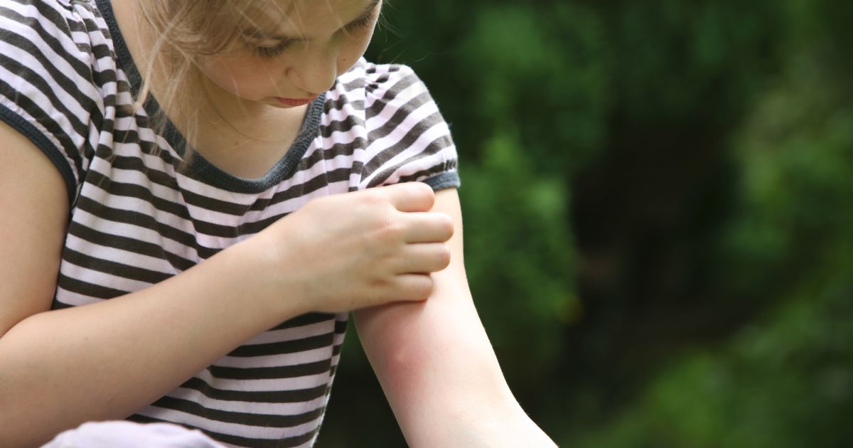 Bug Bite Symptoms You Should Never Ignore Sharecare