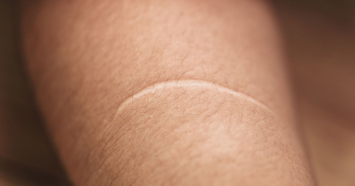 Can You Make Scars Go Away Sharecare