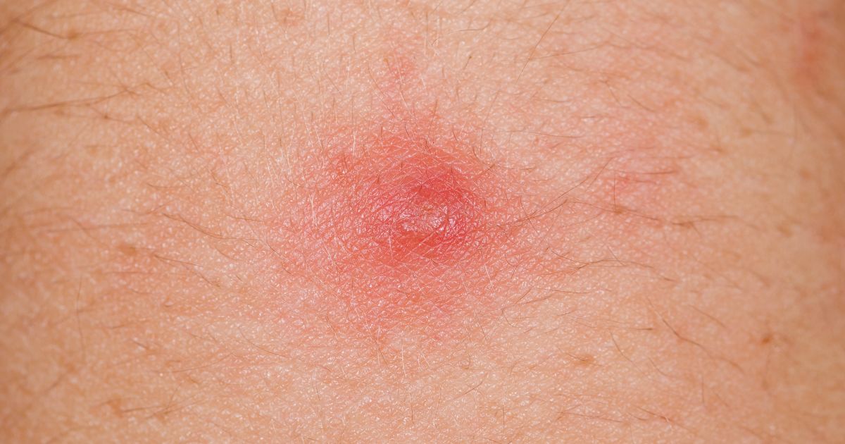 Red Spots on Skin - HubPages