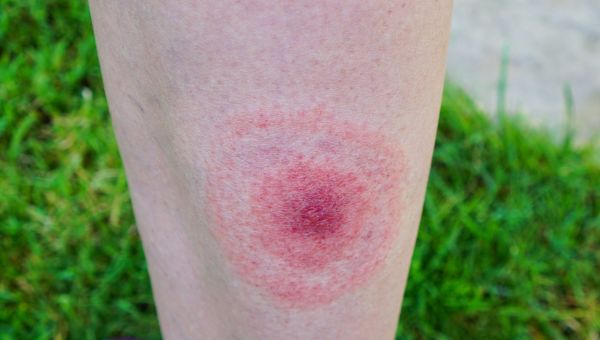 What Bit Me? The Ultimate Guide - First Aid for Life