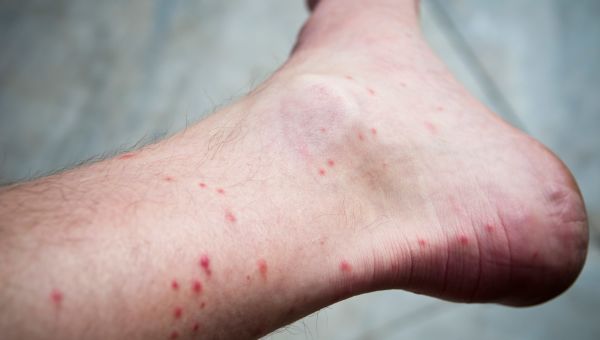 Scabies On Knee Ouch What Bit Me 10 Common Bug Bites First Aid Safety 