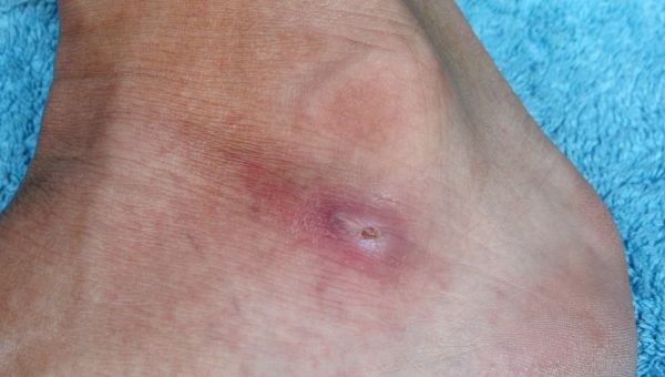 Ouch What Bit Me 10 Common Bug Bites First Aid Safety