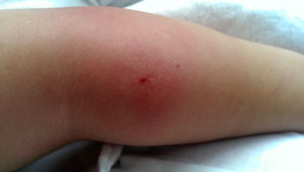 Ouch What Bit Me 10 Common Bug Bites First Aid Safety