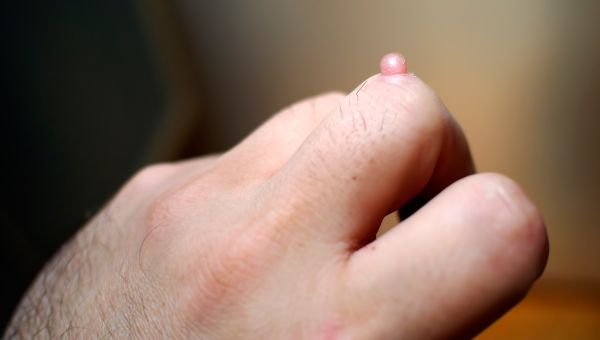 Small, pink wart on the left-hand middle-finger knuckle of a person with light skin