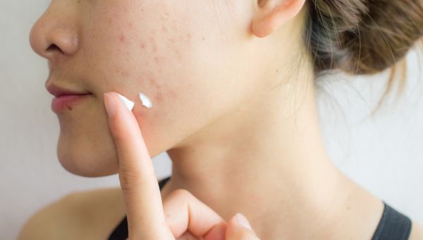 girl with acne pimples